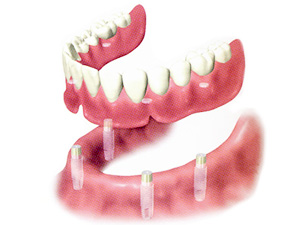 カウンセリング